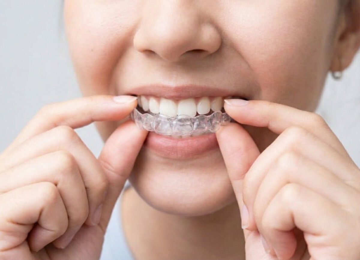 マウスピース矯正